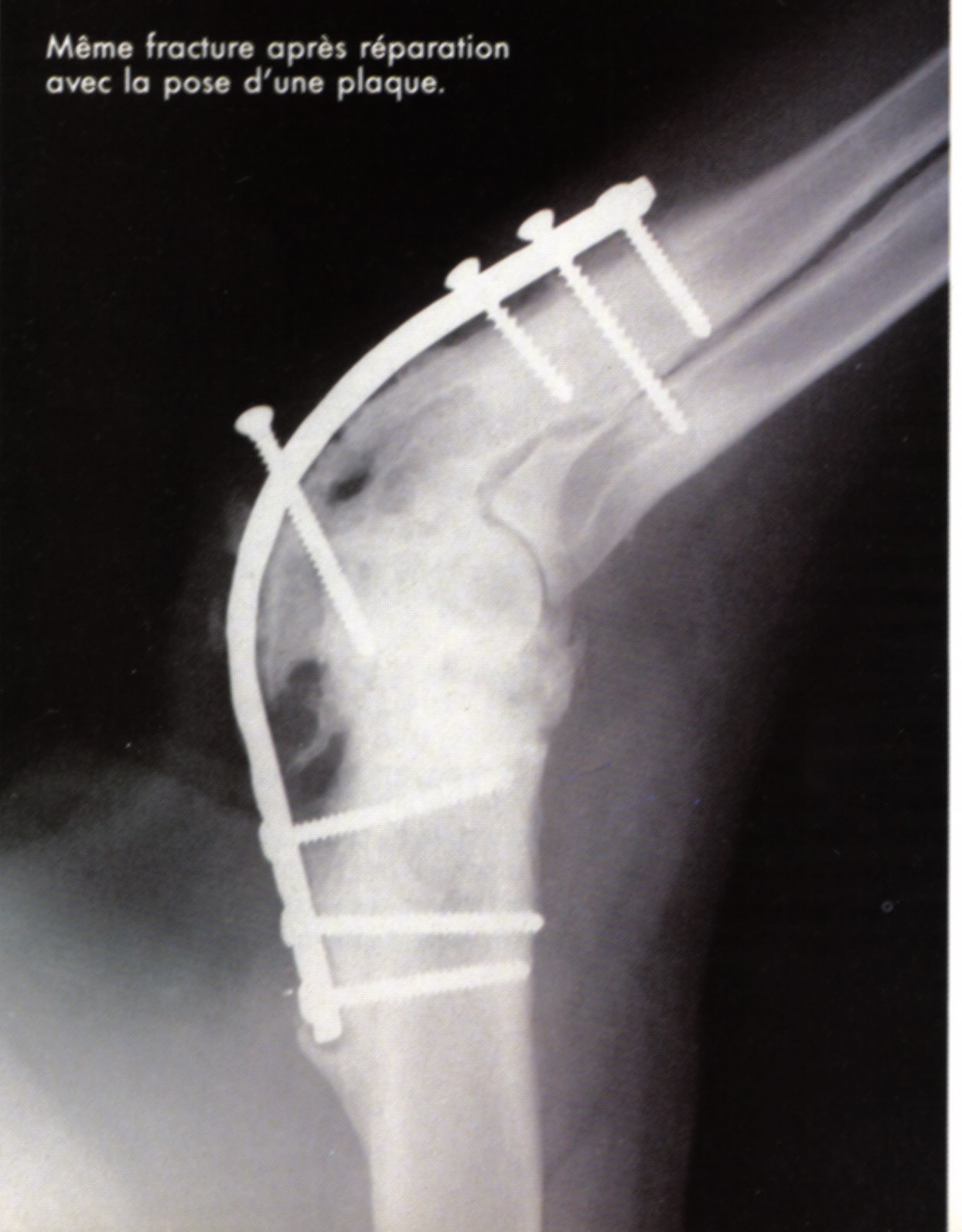 Les Fractures